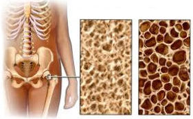 Illustration of normal bone and porous bone due to osteoporosis